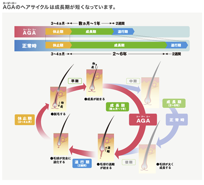 AGA（男性型脱毛症） 白崎医院 増毛 毛が生えてくる 増毛