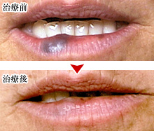 赤色のできものはレーザーで改善 メディカルエステ 高岡美容皮膚科 白崎医院