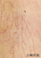 血管拡張 メディカルエステ 高岡美容皮膚科 白崎医院