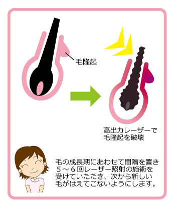 ここが違う、皮ふ科医院で行う医療レーザー脱毛　毛の成長に合わせて間隔を置き、5～6回レーザー照射の施術を受けていただき、次から新しい毛がはえてこないようにします。 メディカルエステ 高岡美容皮膚科 白崎医院