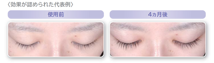 医療用まつげ育毛剤 メディカルエステ 高岡美容皮膚科 白崎医院