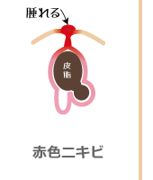 腫れた赤色ニキビ