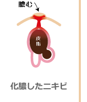 化膿したニキビ メディカルエステ 高岡美容皮膚科 白崎医院