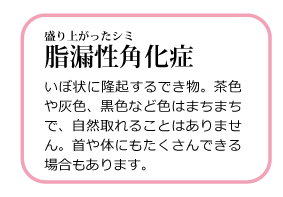 盛り上がったシミ 脂漏性角化症 高岡美容皮膚科 白崎医院